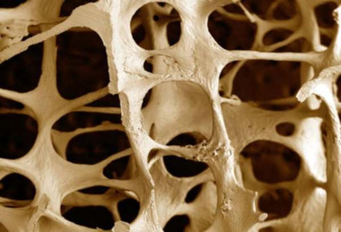 Ossa come vetro, 3,5 mln donne con osteoporosi in Italia