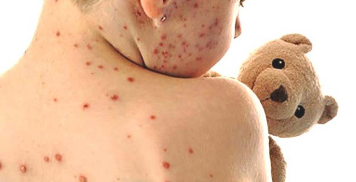 TORINO. Infezioni morbillo e rosolia, vaccinare personale sanitario