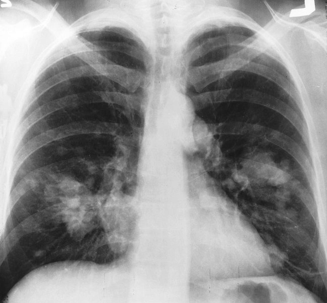 Tumore polmone,da dicembre campagna per diagnosi precoce
