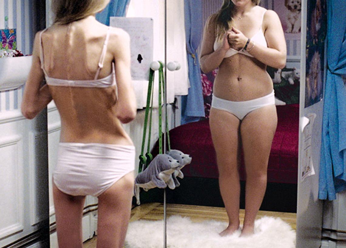 TORINO. Sanità: anoressia e bulimia, casi a 8-9 anni e triplicati
