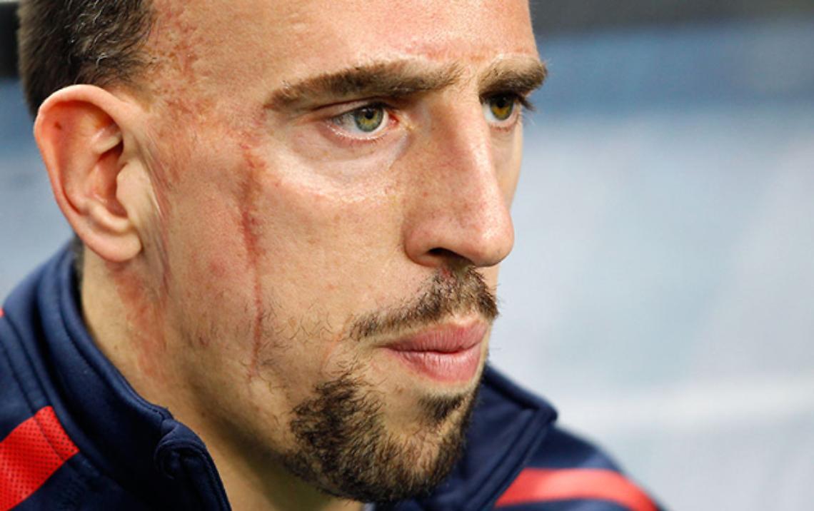 CALCIO. Ribery ancora ko, forse salta la Juventus