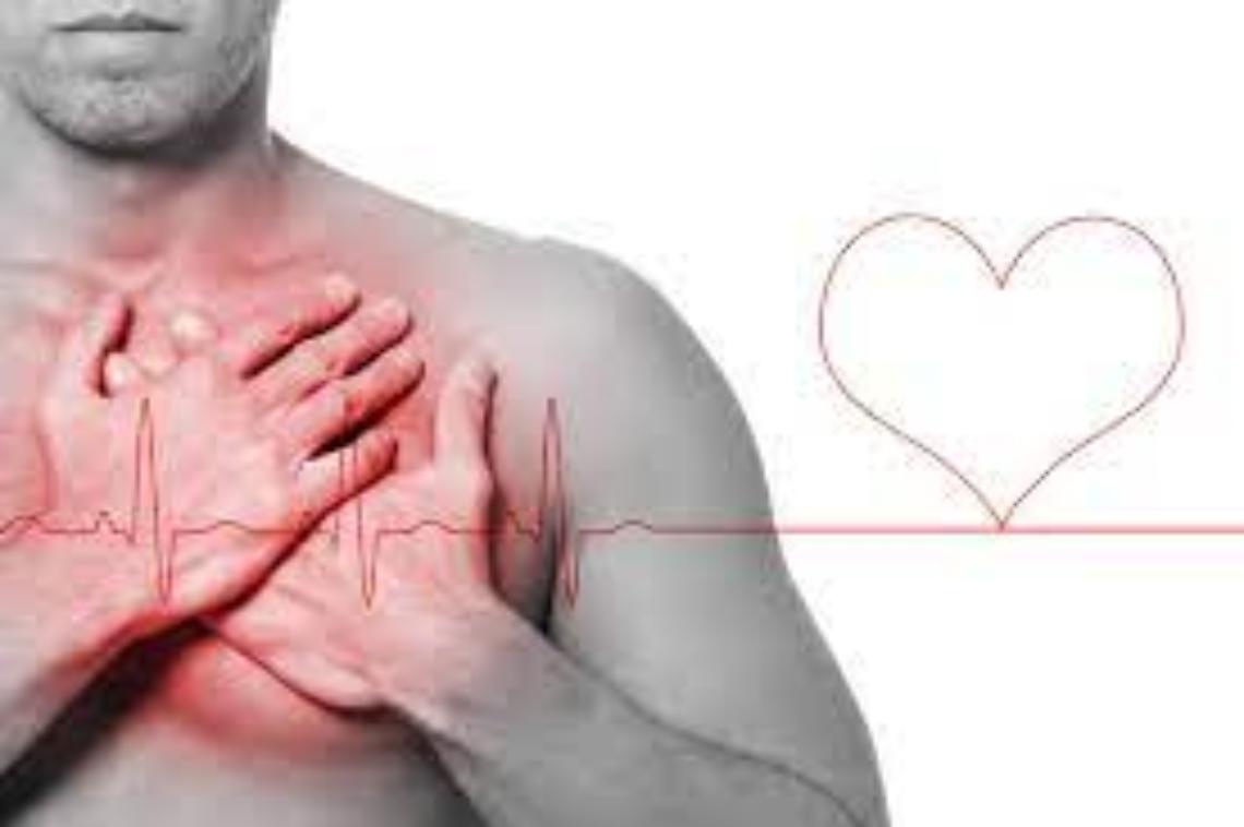 ictus infarto