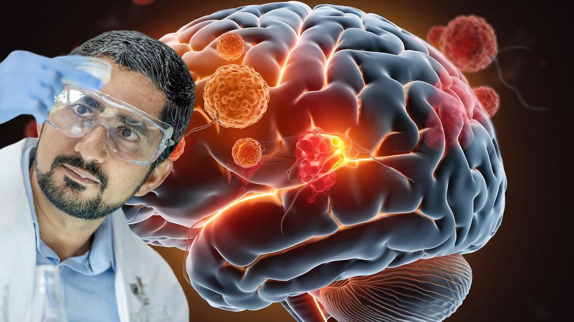 Metastasi cerebrali