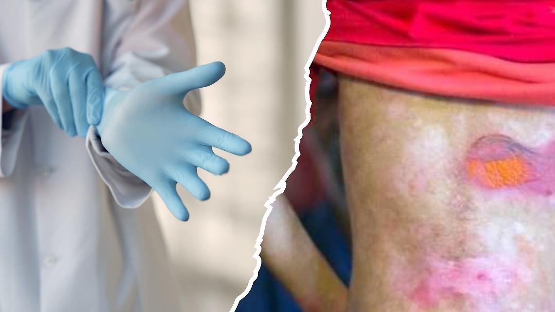 Nuova speranza dalla ricerca per i bambini farfalla