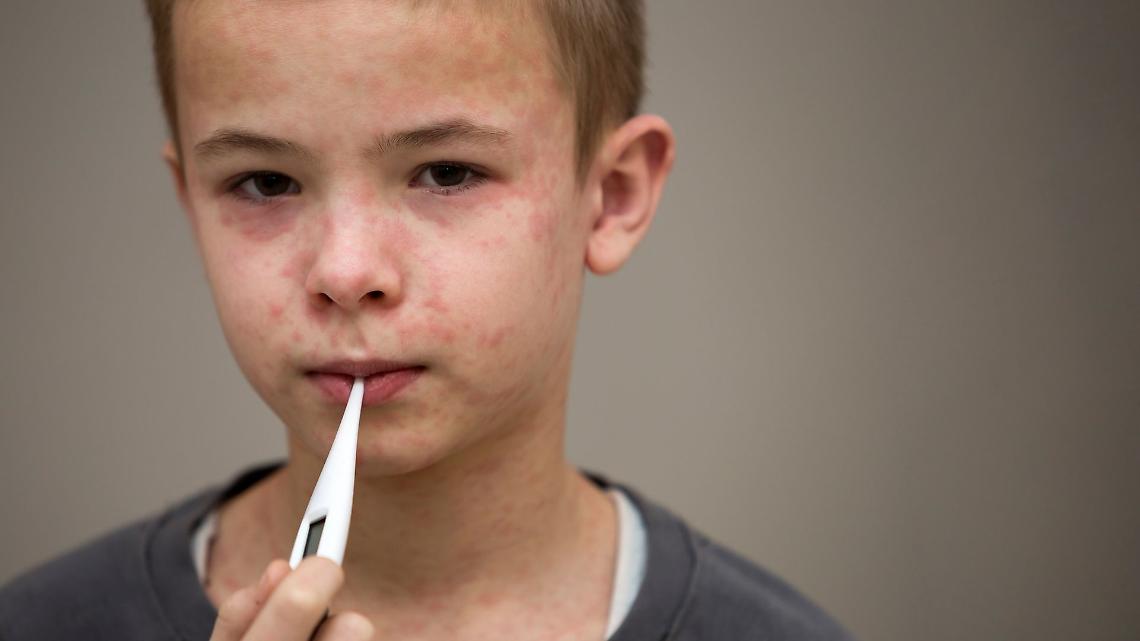 Morbillo, casi in aumento nel 2024