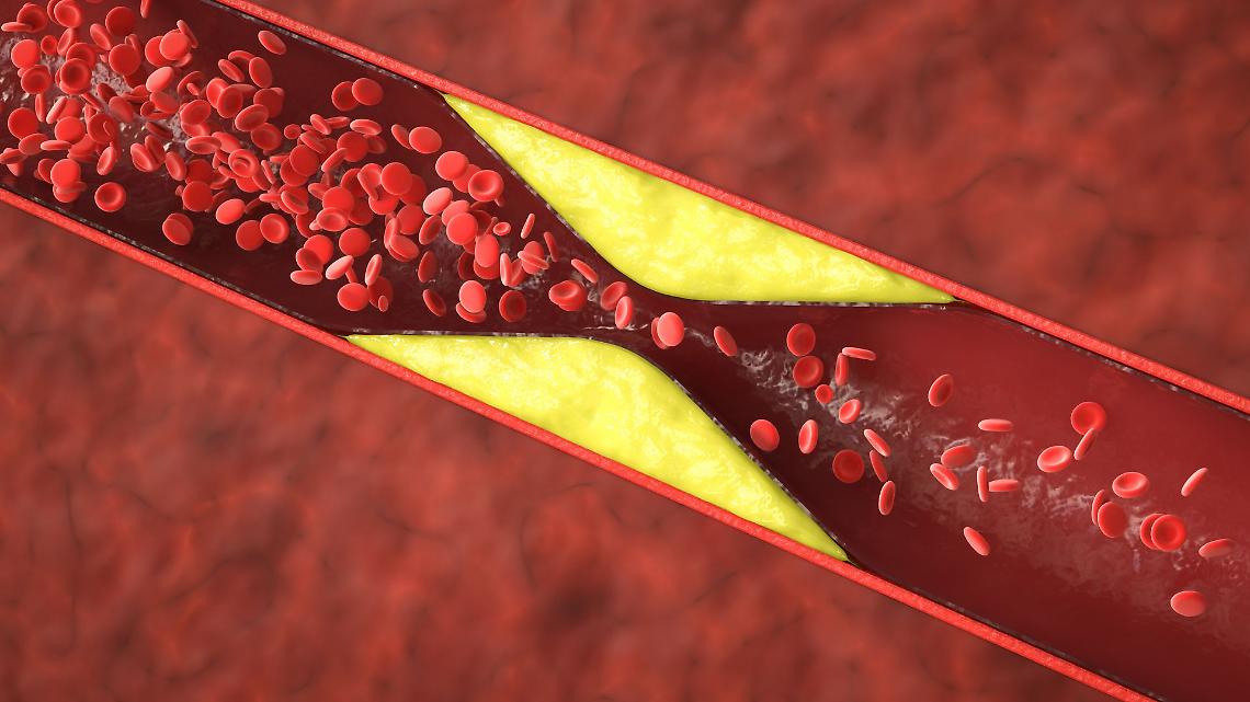Evolocumab riduce drasticamente il rischio di ictus e infarto