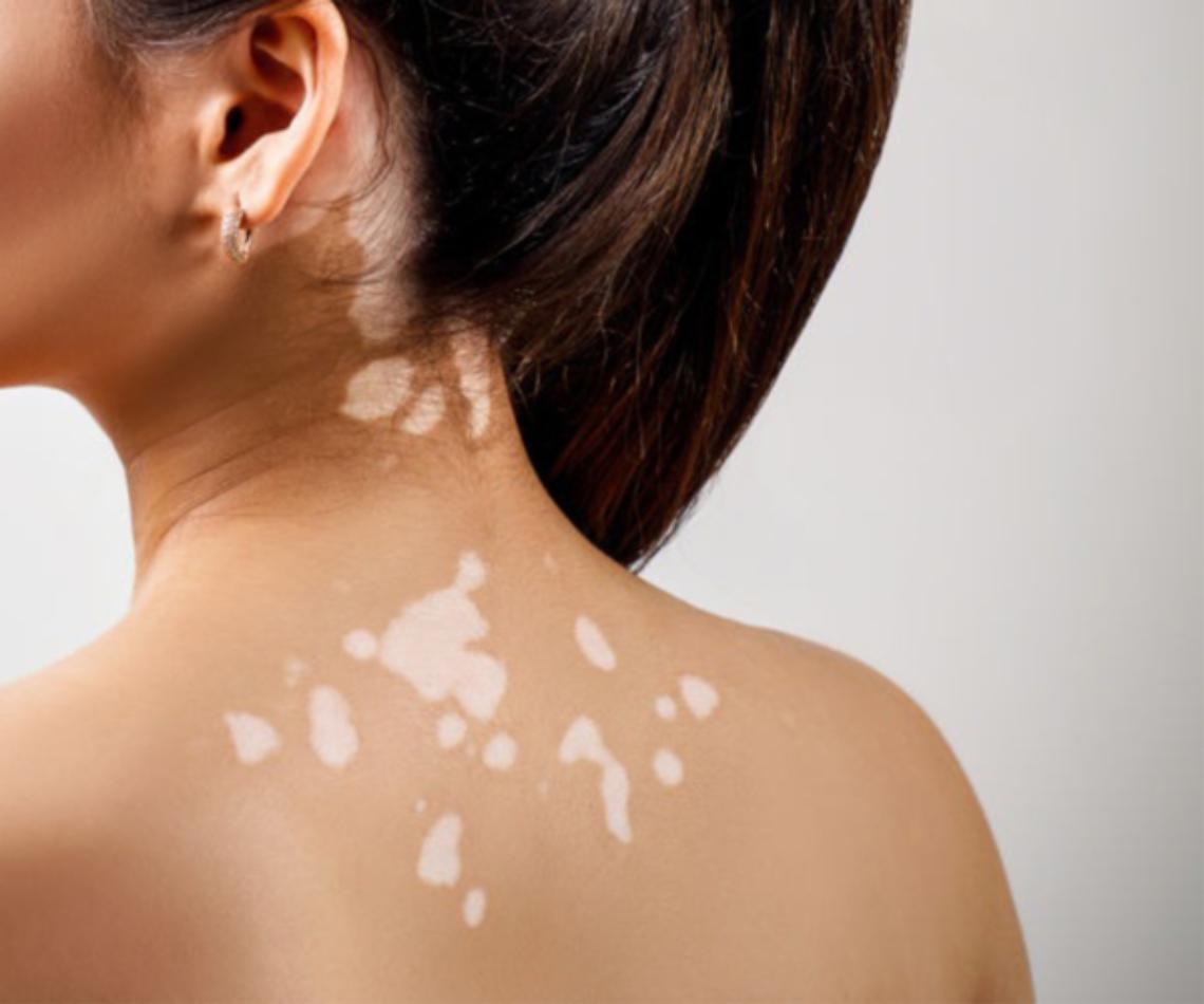 Hai macchie bianche sulla pelle? I dermatologi ti visitano gratis dal 3 all’8 novembre