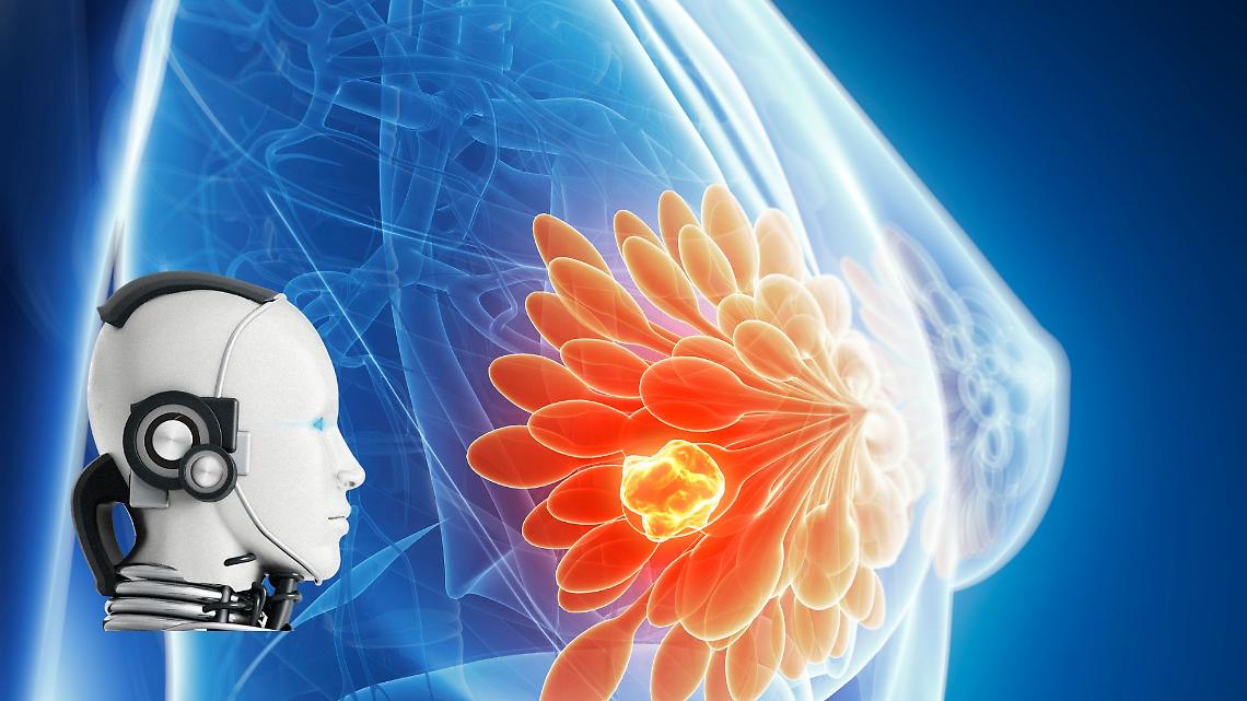 Da 3 studentesse una IA per combattere il tumore al seno