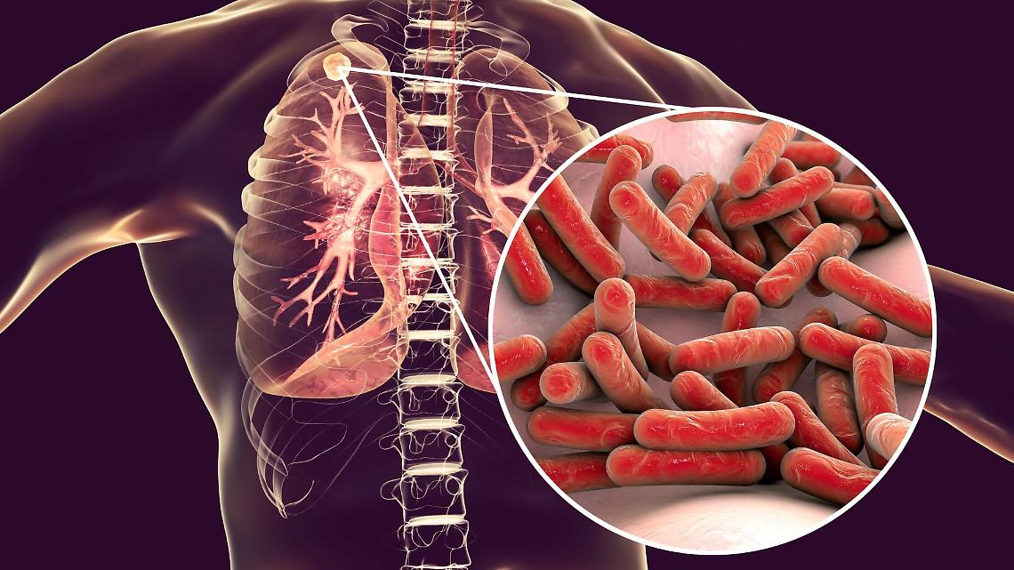 Focolaio di tubercolosi 