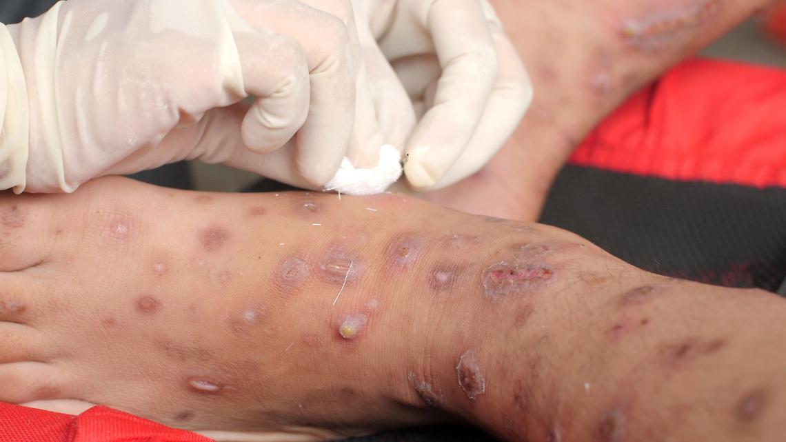 Scabbia in Piemonte, l’impennata che preoccupa: 2.239 casi nel 2024 e 267 focolai