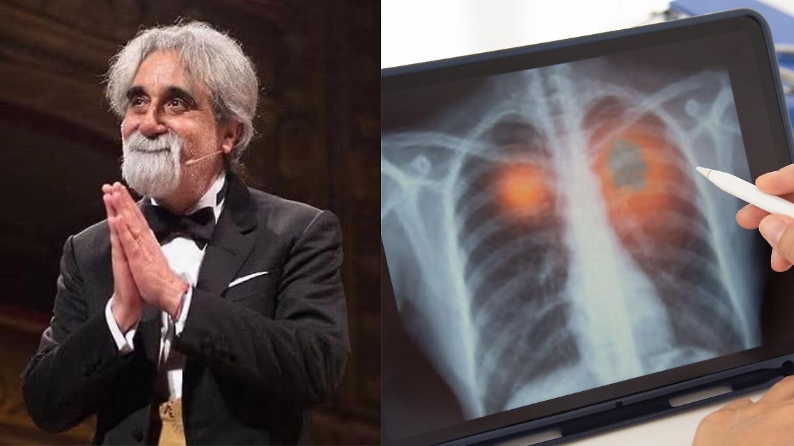 Polmonite interstiziale