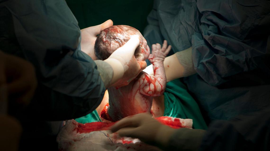 Boom di cesarei in Italia