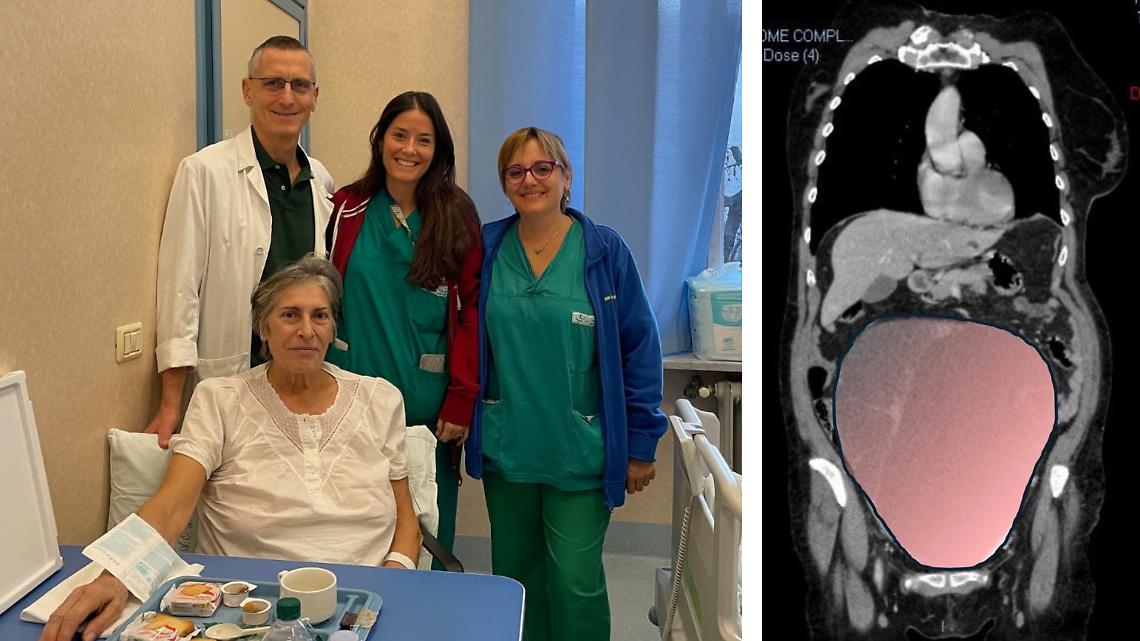 Tumore ovarico di 6 chili scoperto all&rsquo;ultimo: salvata una donna a Natale