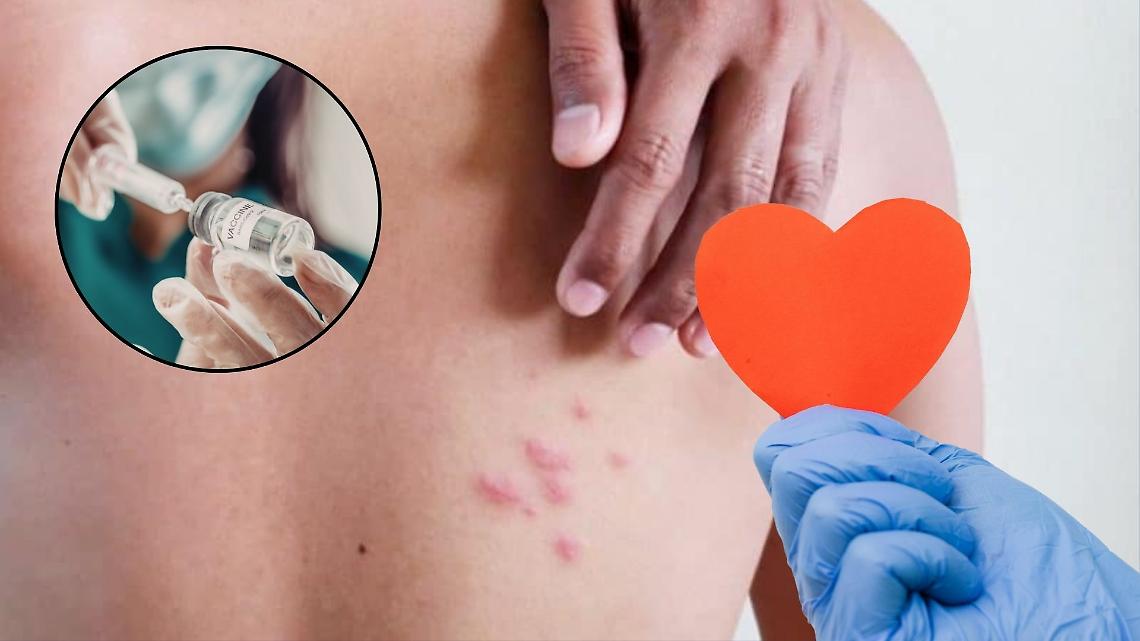 Vaccino contro il fuoco