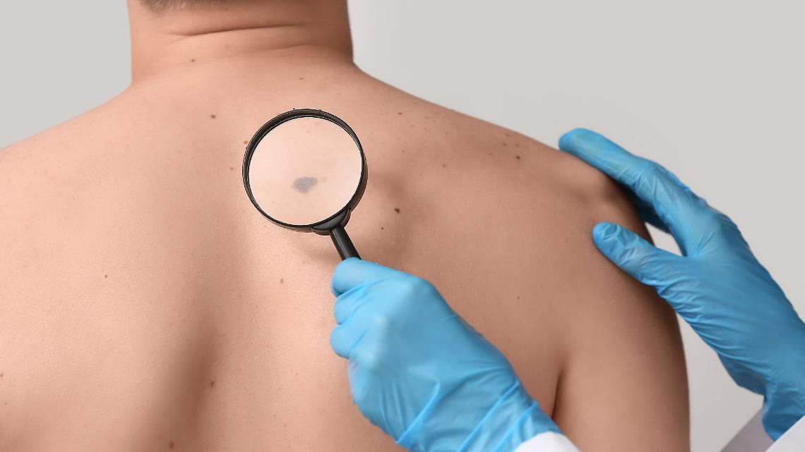 Melanoma, visite gratuite a Cuorgn&egrave;: l&rsquo;ASL TO4 apre le porte ai cittadini
