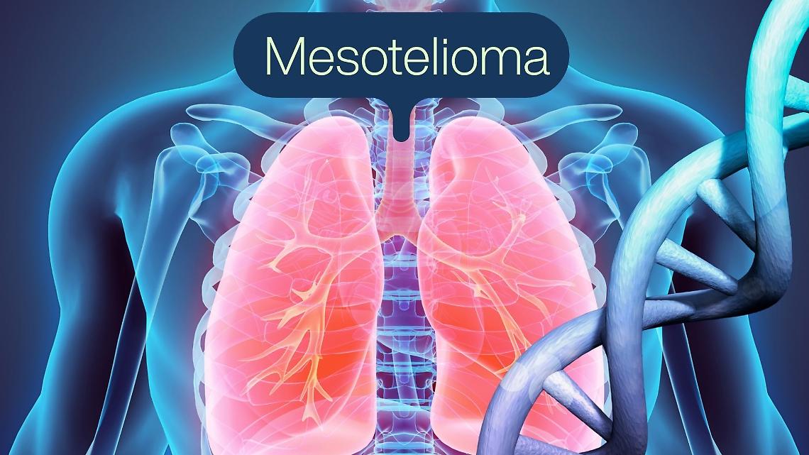 Mesotelioma