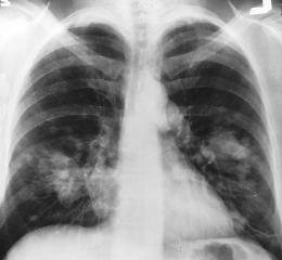 Tumore polmone,da dicembre campagna per diagnosi precoce