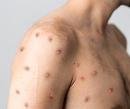 DiaSorin: nuovo reagente rileva il virus del vaiolo delle scimmie