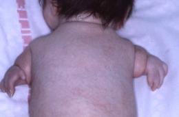 Malformazioni congenite da talidomide: una storia infinita