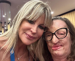 Contro la violenza sulle donne: incontro con Filomena, la prima donna sfregiata con l'acido in Italia