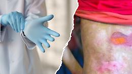 Nuova speranza per i "bambini farfalla": c'è una terapia