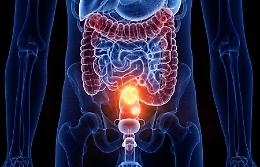 Tumore del colon-retto, incontro gratuito al Koelliker: cosa sapere per salvarsi la vita

