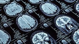 Ictus, immagini radiologiche condivise in tempo reale grazie al cloud: in Piemonte parte il progetto rivoluzionario firmato Azienda Zero