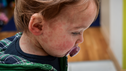 Morbillo fuori controllo: casi triplicati, vaccini dimenticati