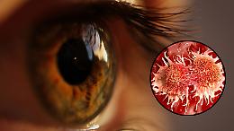 Melanoma oculare, il nemico silenzioso che può colpire anche gli occhi