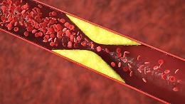 Dal Mauriziano la cura che frena la stenosi carotidea, ecco i numeri che spaventano il bisturi