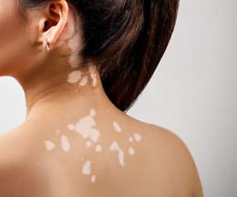 Hai macchie bianche sulla pelle? I dermatologi ti visitano gratis dal 3 all’8 novembre