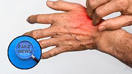 Scabbia alla Casa di Riposo Umberto I di Cuorgnè: arriva il comunicato ufficiale