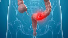 Guarire dal tumore del retto senza intervento: lo studio italiano che cambia il futuro della cura oncologica