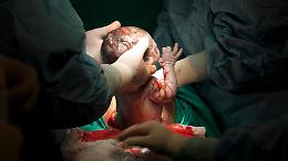 Boom di cesarei in Italia: corsa alla Pma e un futuro demografico appeso ai bisturi