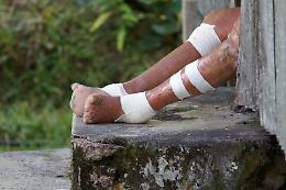 La lebbra &egrave; tornata in Europa dopo 40 anni? Cosa dicono davvero i casi di Romania e Croazia