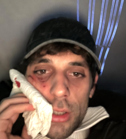 Bresh aggredito da un Dobermann, il volto ferito sui social: le immagini che fanno scattare l&rsquo;allarme tra i fan