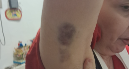 Afferrata e trascinata in corridoio. Medico aggredisce Oss all&rsquo;ospedale di Ivrea