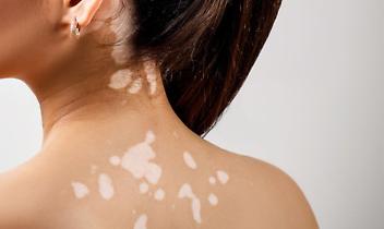 Hai macchie bianche sulla pelle? I dermatologi ti visitano gratis dal 3 all’8 novembre