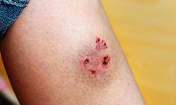 Cane morde un bambino entrato nell'area recintata...