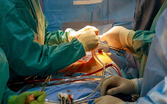 San Giovanni Bosco, impiantata protesi aortica in un uomo con cuore invertito