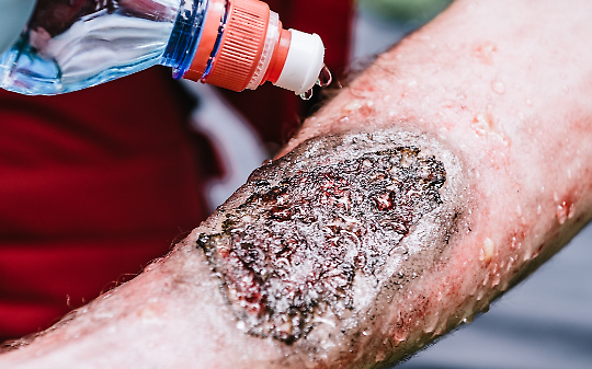 Ustioni e infezioni, la vera corsa contro il tempo dopo l&rsquo;incendio